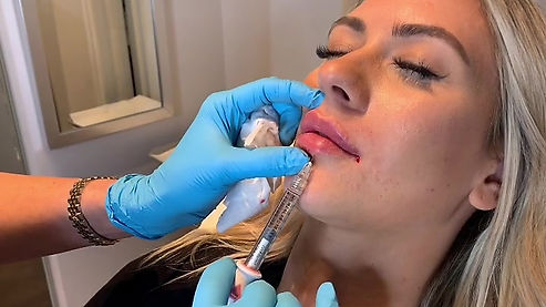 Juvederm Ultra Lip Filler by Heather at Renew Beauty Med Spa
